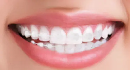 表側ワイヤー矯正 セラミックブラケットの装着イメージ