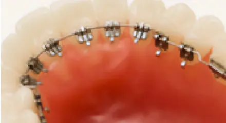 舌側矯正 メタルブラケットの装着イメージ