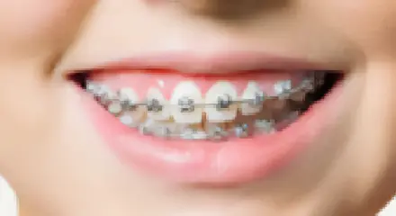 表側ワイヤー矯正 メタルブラケットの装着イメージ