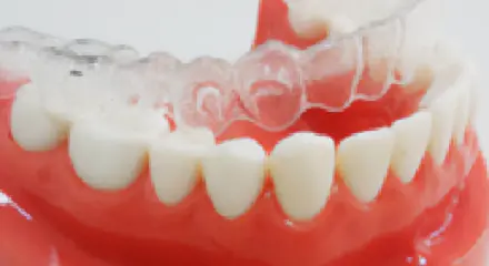 マウスピース矯正の装着イメージ