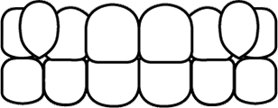 八重歯