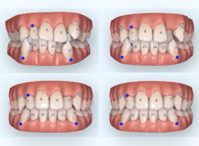 インビザラインのシミュレーションシステムイメージ