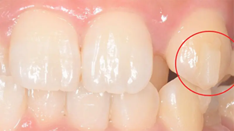 歯を動かすために歯に付ける「アタッチメント」のイメージ