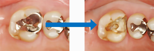 保存可能な歯の選別