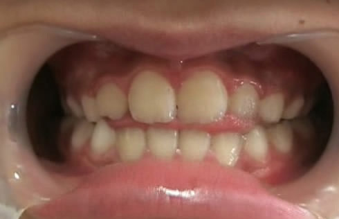 舌 で 歯 を 押す 癖 治す