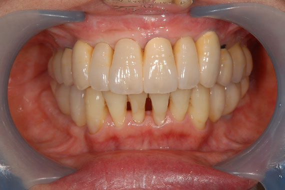 「入れ歯からインプラントに切り替えて何でもおいしく食べられる歯に！」 AFTER画像
