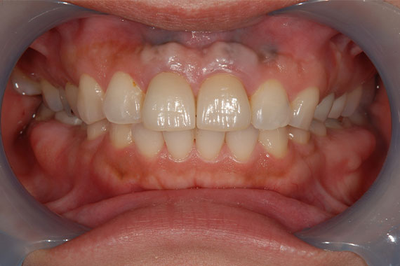 「前歯のインプラントで審美＆機能どちらもUP」 AFTER画像