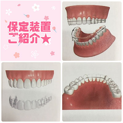 キレイな歯並びを保つために大切なこと