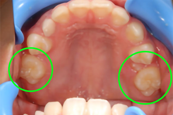 「右側の奥歯が手前に倒れている症例」 BEFORE画像